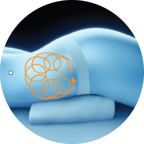 Illustration of a treatment path on the love handles for PicoSure Pro laser treatment in London