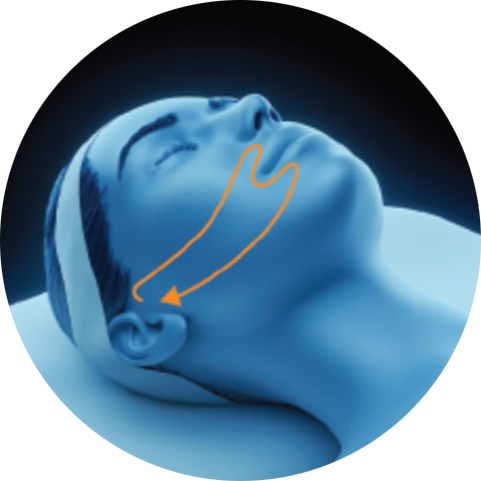 Illustration of a treatment path on the lower cheek for PicoSure Pro laser treatment in London