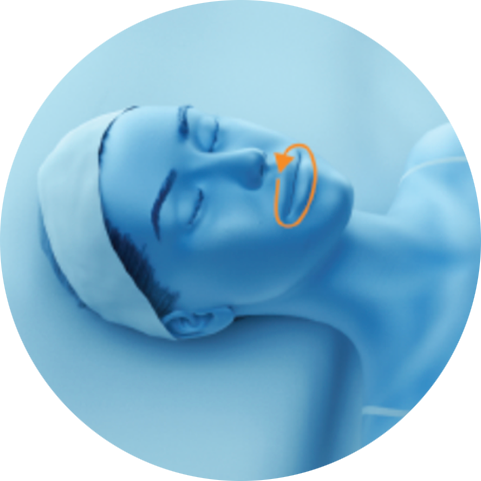 Illustration of a treatment path around the mouth for PicoSure Pro laser treatment in London