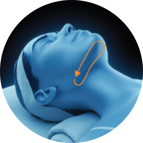 Illustration of a treatment path under the chin for PicoSure Pro laser treatment in London