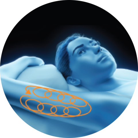 Illustration of a treatment path on the upper arm for PicoSure Pro laser treatment in London