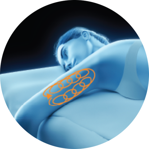 Illustration of a treatment path on the upper arm for PicoSure Pro laser treatment in London