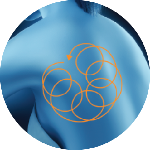 Illustration of a treatment path on the upper back for PicoSure Pro laser treatment in London