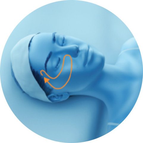 Illustration of a treatment path on the upper cheek for PicoSure Pro laser treatment in London